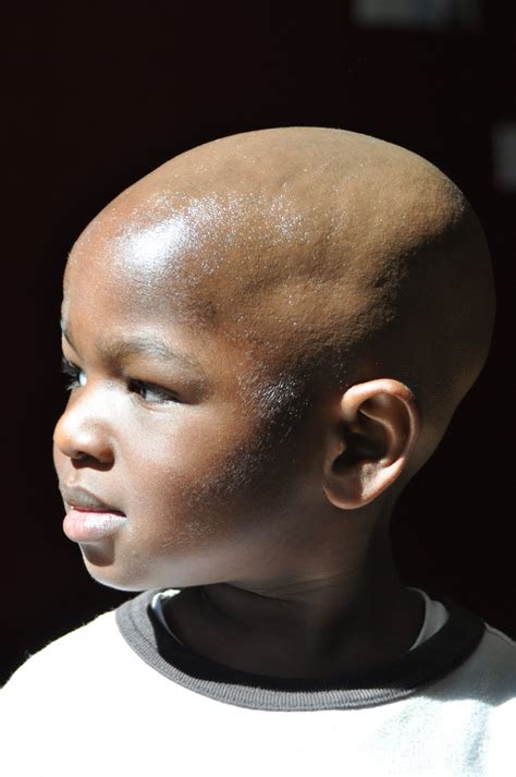 black bald kid|bald children.